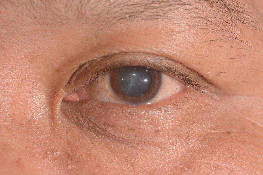 Cataract Treatment