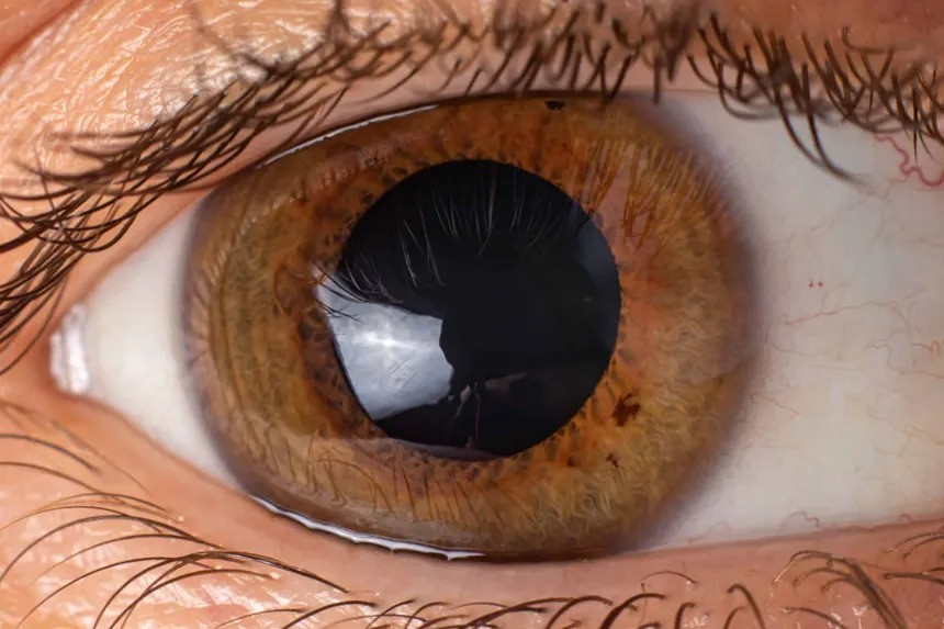 Cornea Treatment